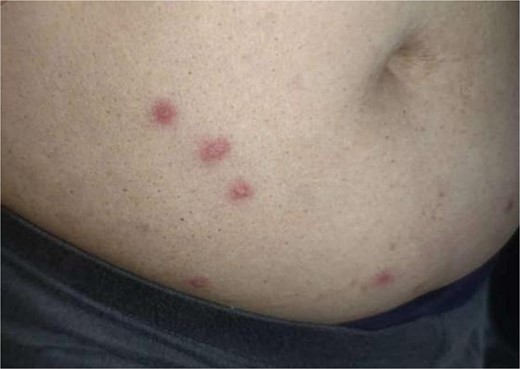 Multiple papules on the patient’s abdomen.