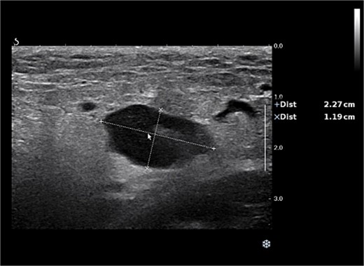 Color Doppler ultrasound of the right inguinal lymph node.
