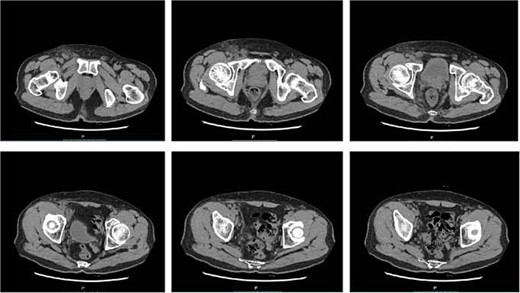 Pelvic CT on the 15th day after surgery.
