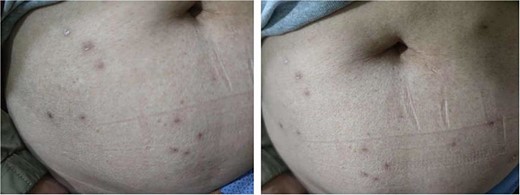 The abdominal papules and pustules had disappeared on the 27th day following surgery.