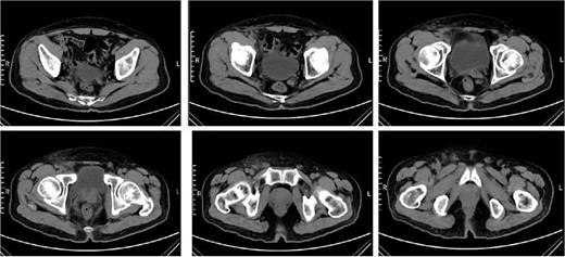 Pelvic CT on the 27th day after surgery.