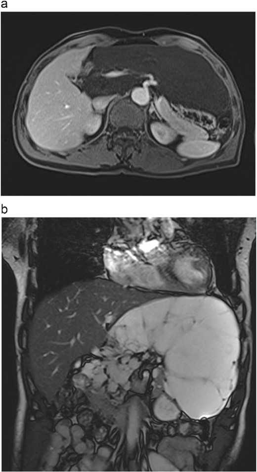 (a) Abdominal contrast-enhanced scan in the arterial phase shows the tumour compressing the portal vein, common hepatic artery, and celiac trunk. (b) T2-weighted MRI image shows the tumour with high signal intensity and no solid components.