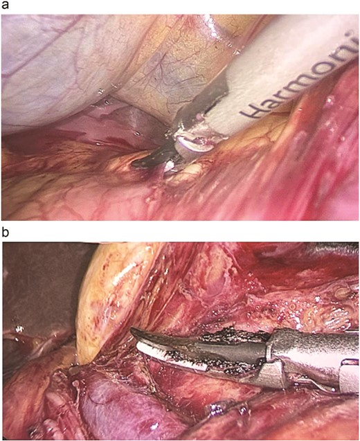 (a) Intraoperative view shows the tumour extending beyond the right side of the duodenal ligament. (b) Laparoscopic dissection of the tumour from the portal vein.