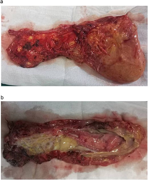 (a) The tumour is completely excised. (b) The tumour is cut open, revealing milky white fluid and a small amount of fatty tissue.