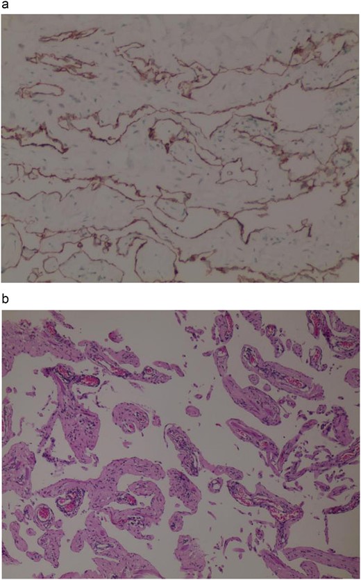 (a) Immunohistochemistry D2–40 (+). (b) Haematoxylin and eosin staining.