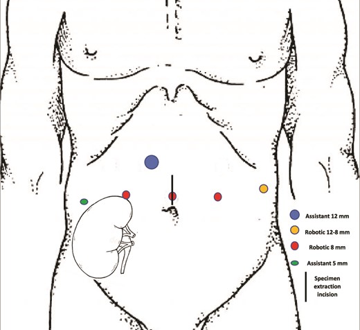 Adapted port placement for robot assisted procedure.