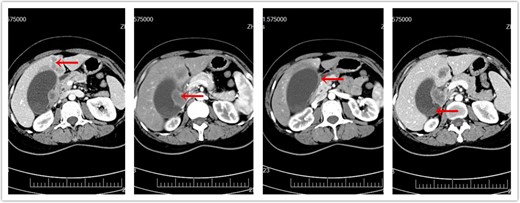 CT of abdomen prior to surgery. (a) Metastatic liver masses. (b) Enlarged lymph nodes. (c) Invasion of duodenum. (d) Original gallbladder tumor.