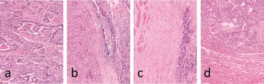 Pathology results. (a) Low to moderate differentiation gallbladder adenocarcinoma. (b) Lymphatic metastasis. (c) Duodenum wall invasion. (d) Hepatic metastasis.