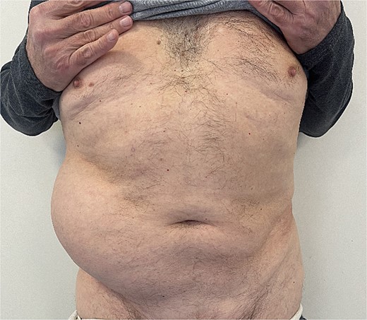 Preoperative soft mass of the right ventrolateral abdominal wall