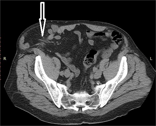 Non-contrast abdominal CT, an arrow pointing to the abdominal wall defect and intestine protrusion