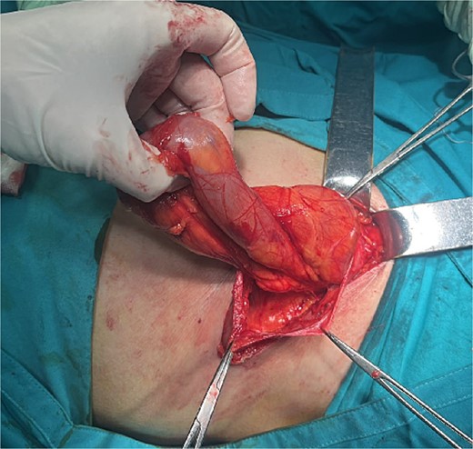 Hernia sac with small intestine loops inside that remained intact during dissection