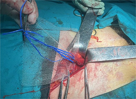 Placement of the polypropylene mesh 15 × 12 cm after dissection of the spermatic cord