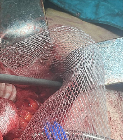 Mesh fixation to the pubic tuberculum and conjoint tendon with a laparoscopic taker