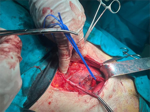 Final mesh position with the opening for the spermatic cord