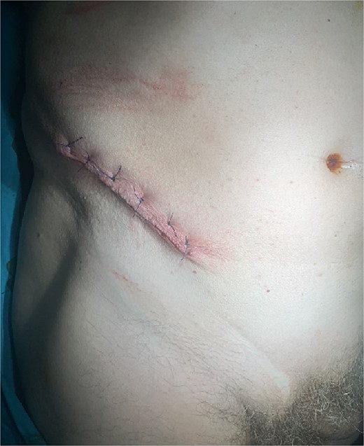 Closure of the skin incision