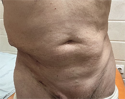 Postoperative abdominal wall restoration