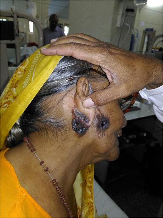 Nodular ulcerative lesion on the right cheek and ear lobule.