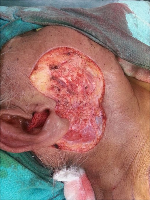 Extensive defect across the right cheek, ear lobule, and retroauricular area after lesion excision.