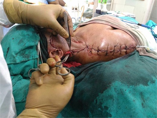 Flap inset into the defect with donor site closer and suction drain in place.