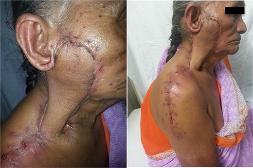 Healed surgical site at 15 days post-op.