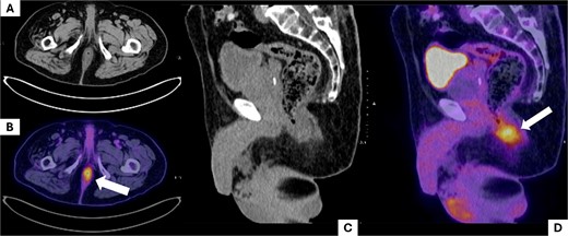 Positron emission tomography (PET-CT) scan. The images show the region corresponding to the anal canal. A and B show the affected anatomical region in axial slices. (A) Shows the anal canal with slight asymmetrical thickening predominantly on the left side, with no suspicious adenopathies; (B) shows uptake corresponding to the increase in local metabolism secondary to the tumor lesion (white arrow). C and D show sagittal slices of the pelvic region, where uptake is observed at the level of the anal canal (white arrow).