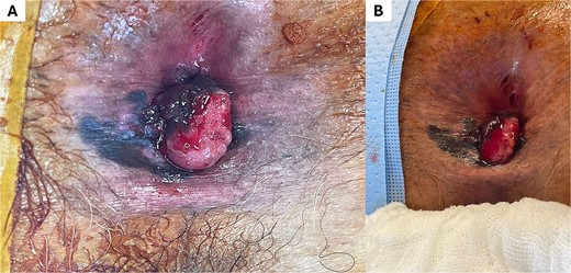 Lesion corresponding to anorectal melanoma. Observe in (A) and (B) the lesion with left lateral predominance, ulcerated surface, and irregular hyperpigmented borders.