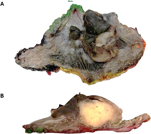 Wide local excision surgical specimen. (A) There is an exophytic tumor with irregular borders. (B) Nodular, submucosal, poorly demarcated tumor.