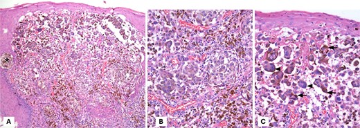 Hematoxylin and eosin staining. (A) Display of malignant neoplasm with solid growth pattern and forming nests (*). (B, C) At higher magnification, pleomorphic, polygonal cells with vesicular nuclei, prominent nucleolus, and abundant cytoplasm are observed. Note the pigment in the cytoplasm of the cells, which corresponds to melanin.