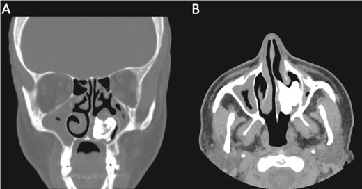 A CT scan with (A) coronal view and (B) axial view showing a well-defined expansile heterogeneous calcified/ossified lesion occupying the inferior aspect of the left nasal cavity.