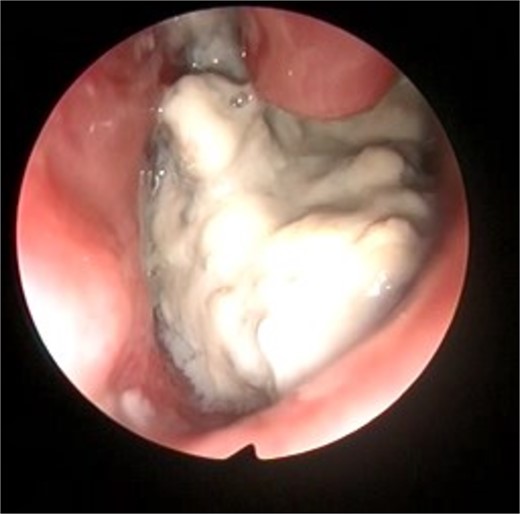 Intraoperative left nasal endoscopic view showing a whitish mass lying under the floor of the inferior turbinate.
