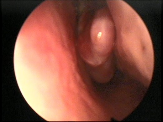 Postoperative nasal endoscopic view showing a clear left nasal cavity.