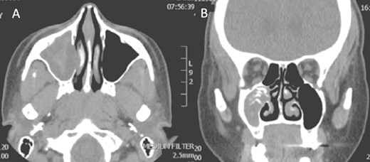 Axial (A) and coronal (B) images of a nonenhanced CT scan of the paranasal sinuses showing right maxillary sinus complete heterogenous opacification.