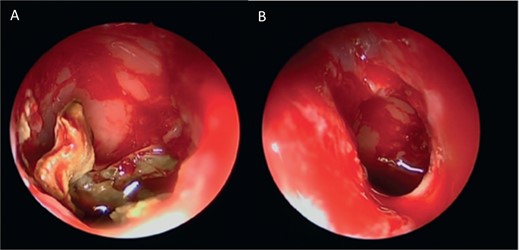 Intra-operative endoscopic view (A) right middle meatal antrostomy showing fungal debris, (B) clean right maxillary sinus after removal of the debris.