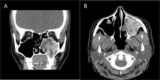 Coronal (A) and axial (B) CECT scan images showing left complete maxillary sinus heterogenous opacification.