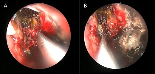 Intra-operative endoscopic maxillary examination (A and B) showing invasive fungal debris.