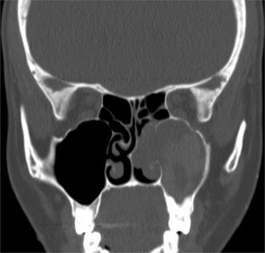 Coronal NCCT image of the paranasal sinuses showing isolated left complete heterogenous maxillary sinus opacification with obstructed left osteomeatal complex.
