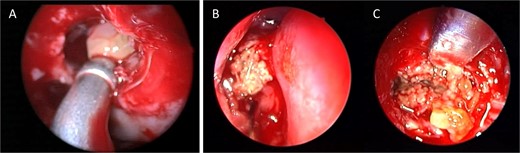 Intra-operative endoscopic view showing (A) polyps in the left osteomeatal complex with (B and C) fungal mud and mucin.