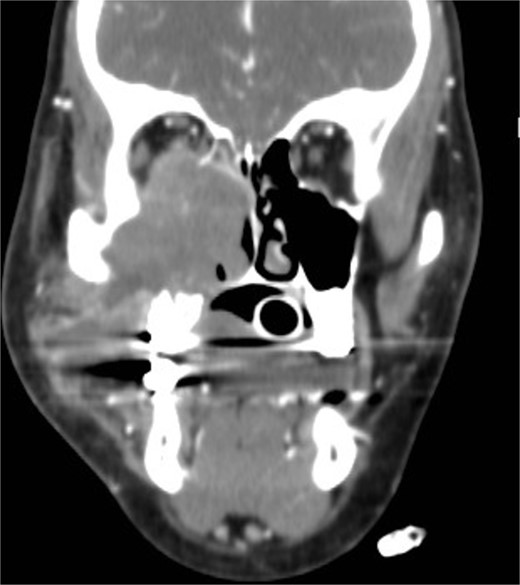 Coronal NCCT image of the paranasal sinuses showing isolated destructive right maxillary sinus lesion violating the right orbit.