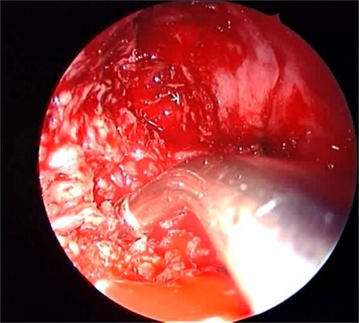 Intra-operative endoscopic view showing invasive fungal granuloma in the right maxillary sinus.
