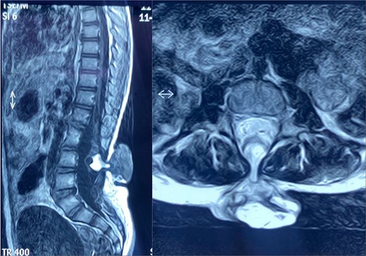 Sagittal (left) and axial (right) spinal MRI shows a meningocele sac.