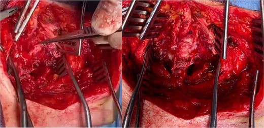 Intraoperative view demonstrates lipoma (the tip of the forceps in the left picture) and after removal of lipoma (right).