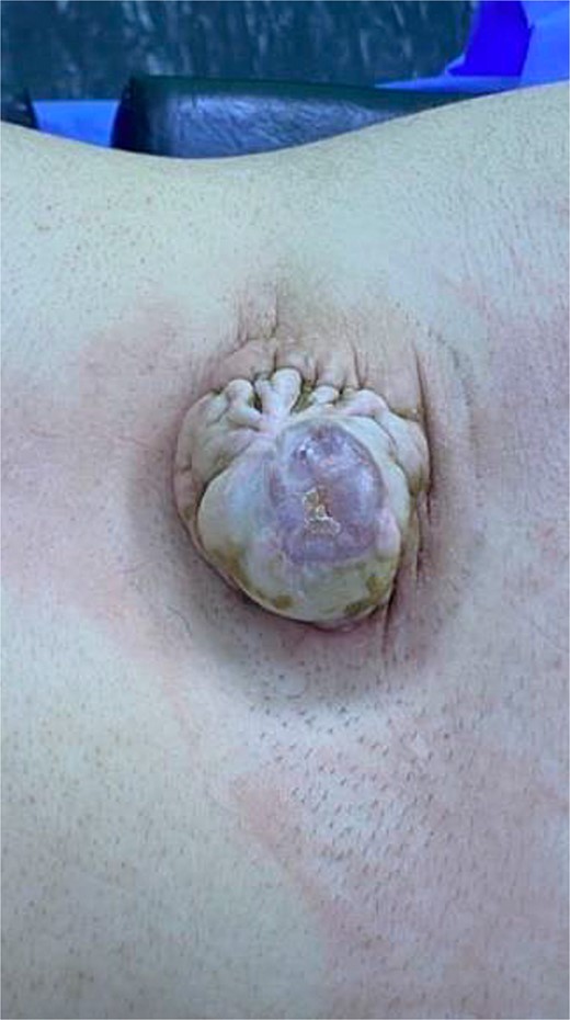 A meningocele sac in lumbosacral area.