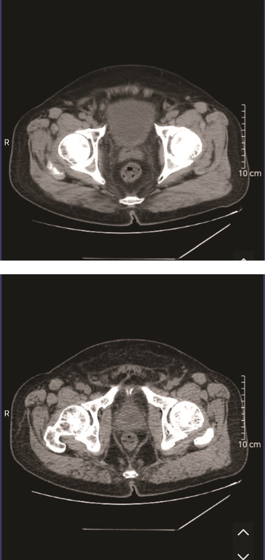 The CT scan results indicated prostate hyperplasia, with MRI recommended if deemed necessary.