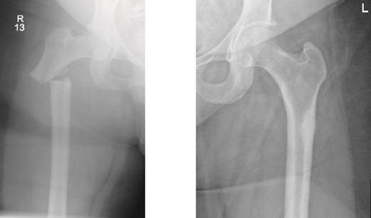 Anteroposterior (AP) view of the right and left femurs pre-operative. With ismuths of 7.7 in R and 6.9 in L