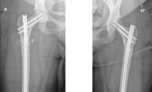 Anteroposterior (AP) view of the right and left femurs after CRIF with IM nail.