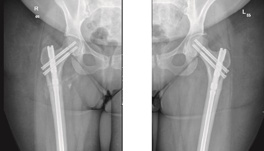 6-weeks follow-up anteroposterior (AP) view of the right and left femurs after CRIF with IM nail.