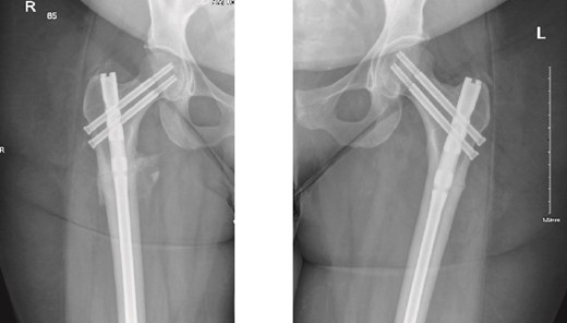6-months follow-up anteroposterior (AP) view of the right and left femurs after CRIF with IM nail.