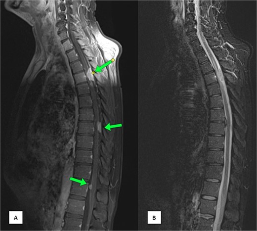 MRI of the spine (A) sagittal T1-weighted fat-saturated post-contrast image and (B) sagittal Short Tau Inversion Recovery (STIR) sequence demonstrating multiple intra-spinal, extra-medullary meningeal-based enhancing lesions. The largest lesion measures 22 × 11 mm at the D4 level.