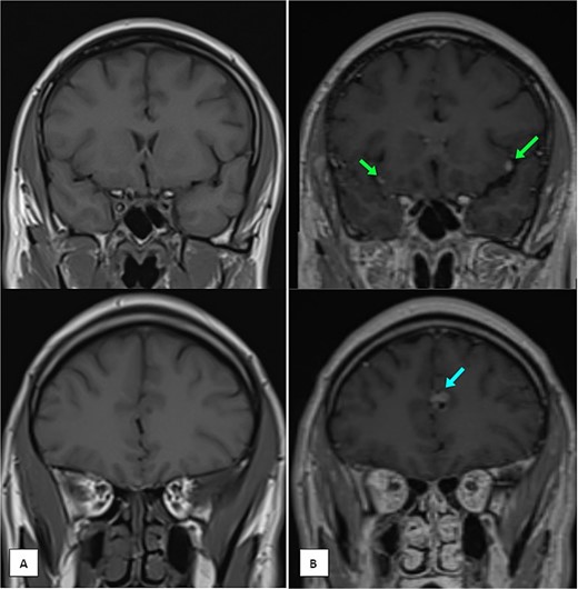 MRI of the brain (A) coronal T1 pre-contrast and (B) coronal T1 post-contrast images showing multiple leptomeningeal enhancing nodules. The largest are seen at the left frontal parafalcine region (as shown in the single arrow) and bilateral sylvian fissures (as shown in the two arrows).
