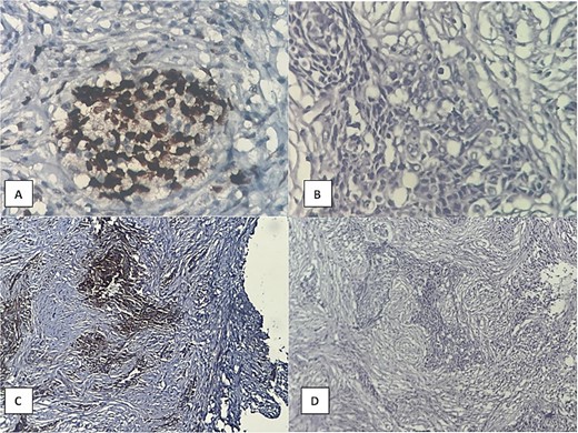 Histopathological examination showing (A) prominent PD-L1 expression, (B) high power of tumor cell infiltration, (C) P63 expression, (D) malignant epithelial cell infiltration of desmoplastic stroma.